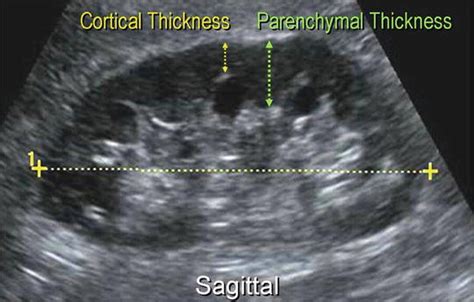 cortical thickness measurement|normal cortical thickness of kidney.